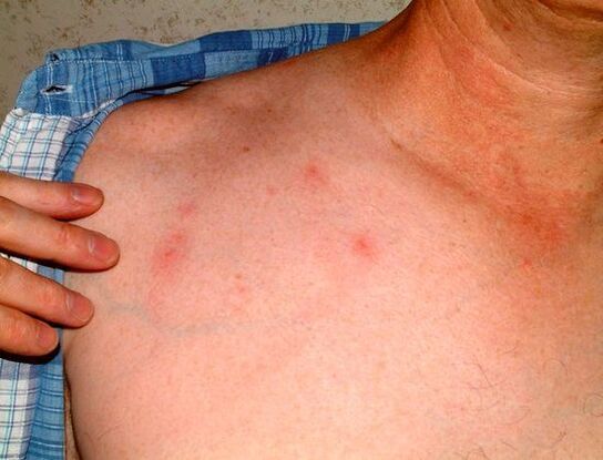 parasiitide sümptomid naha all