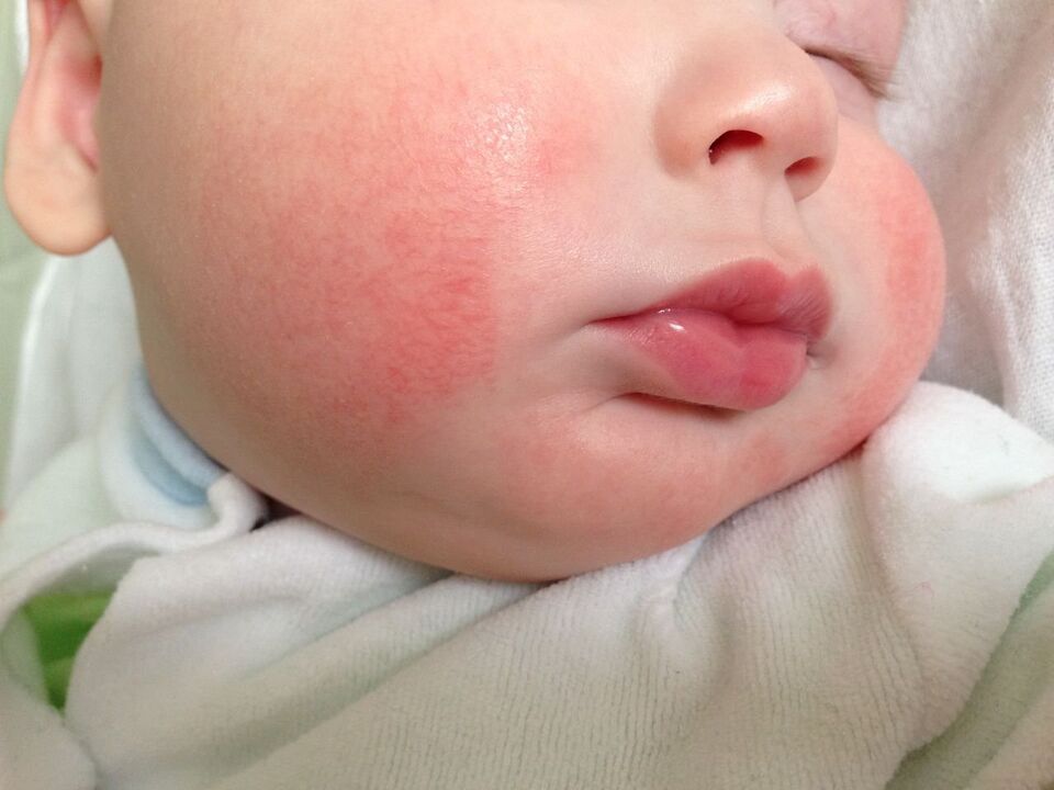 Usside märk lapsel on allergiline urtikaaria